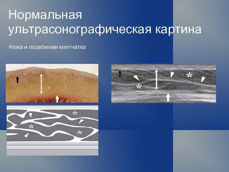 Нормальная ультрасонографическая картина Кожа и подкожная клетчатка 