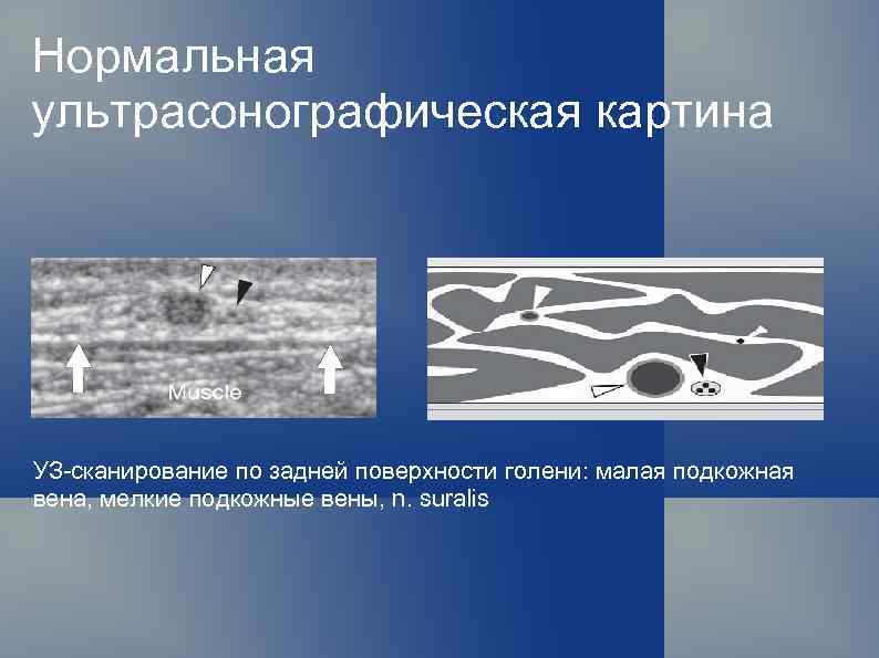 Нормальная ультрасонографическая картина УЗ-сканирование по задней поверхности голени: малая подкожная вена, мелкие подкожные вены,