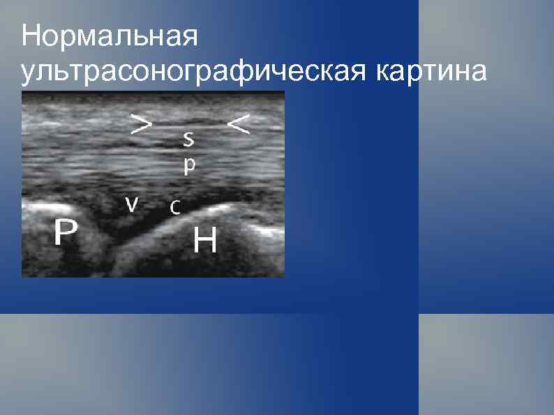 Нормальная ультрасонографическая картина 