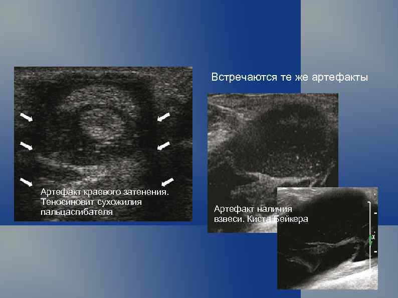 Встречаются те же артефакты Артефакт краевого затенения. Теносиновит сухожилия пальцасгибателя Артефакт наличия взвеси. Киста