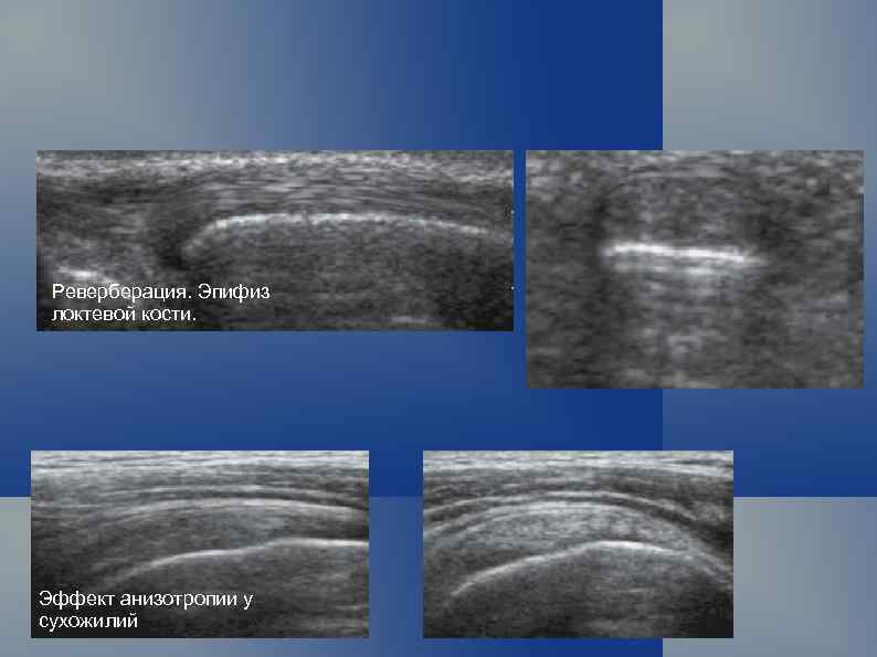 Реверберация. Эпифиз локтевой кости. Эффект анизотропии у сухожилий 