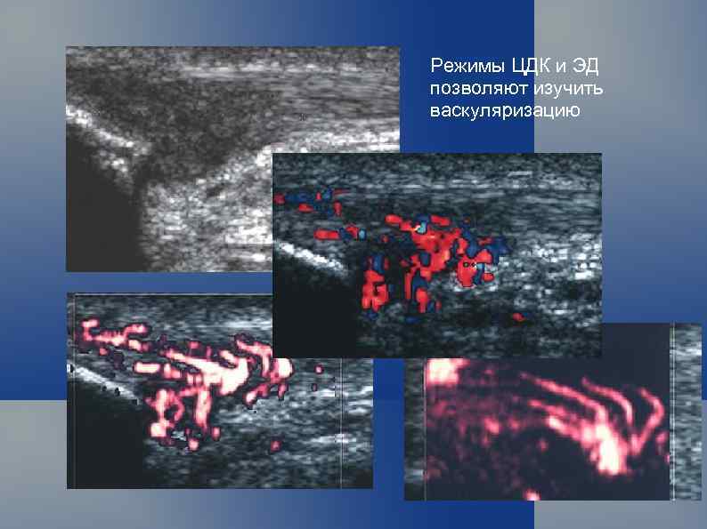 Режимы ЦДК и ЭД позволяют изучить васкуляризацию 