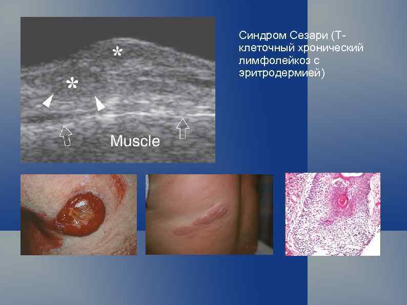Синдром Сезари (Тклеточный хронический лимфолейкоз с эритродермией) 