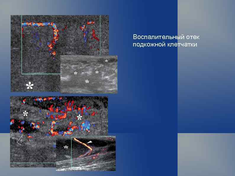 Воспалительный отек подкожной клетчатки 