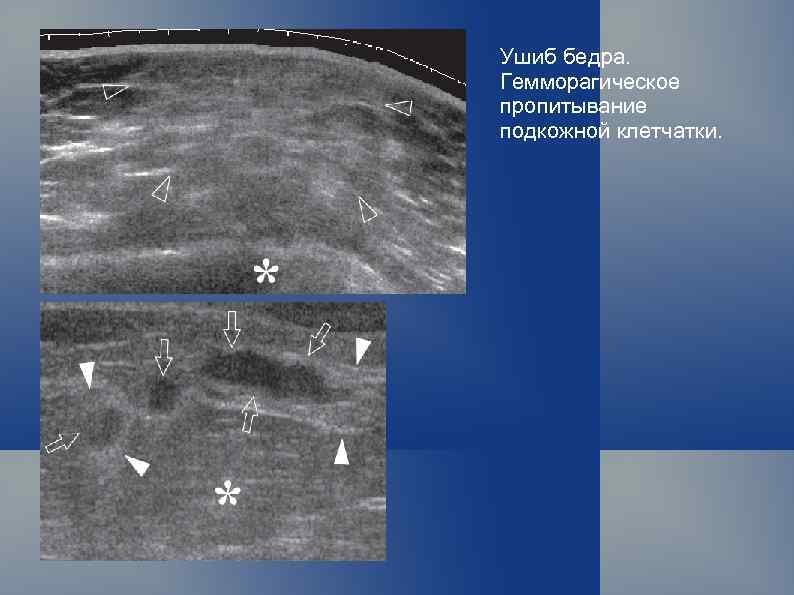 Ушиб бедра. Гемморагическое пропитывание подкожной клетчатки. 