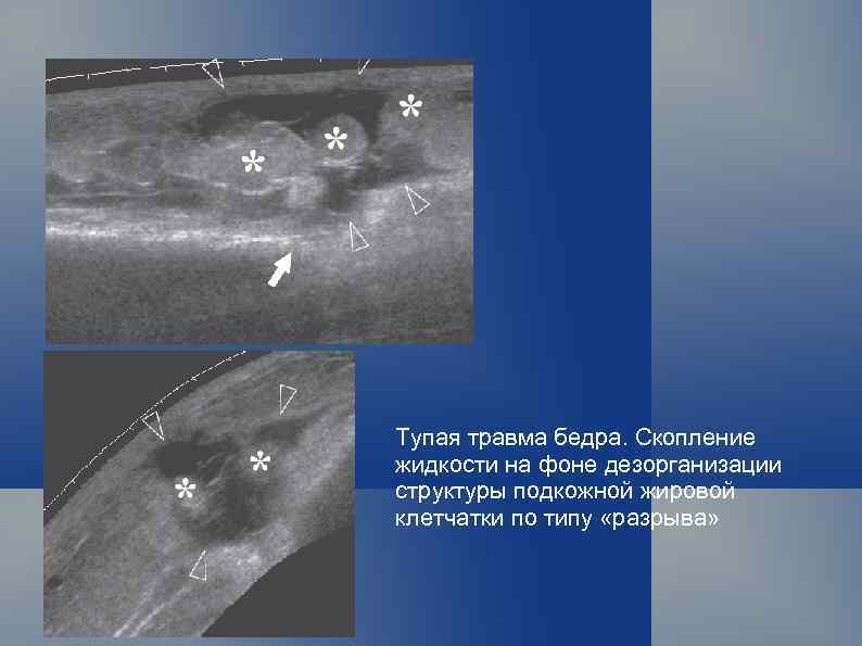 Тупая травма бедра. Скопление жидкости на фоне дезорганизации структуры подкожной жировой клетчатки по типу