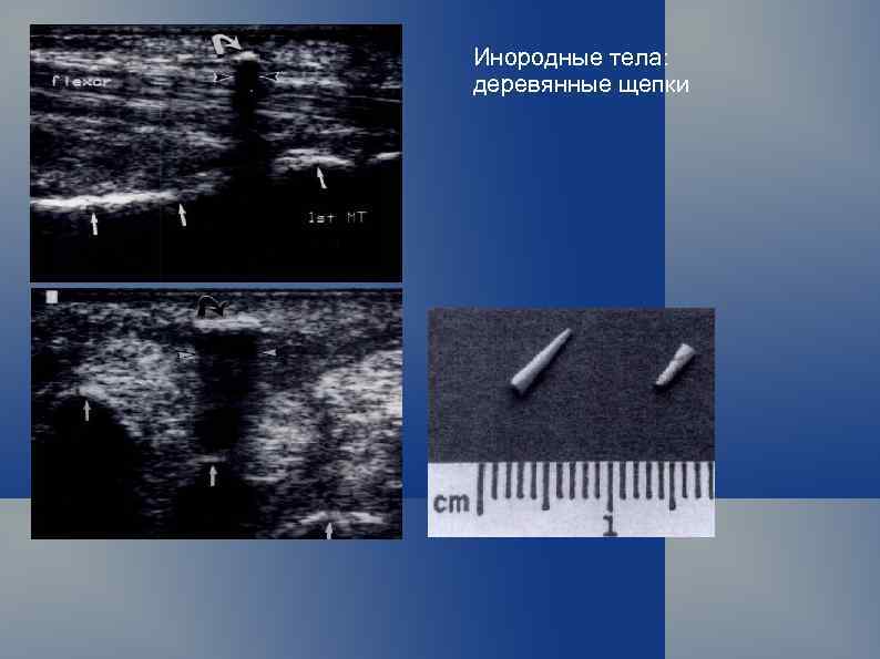 Инородные тела: деревянные щепки 