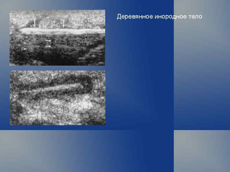 Деревянное инородное тело 