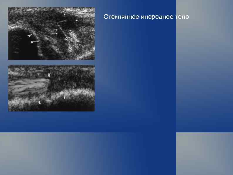 Стеклянное инородное тело 