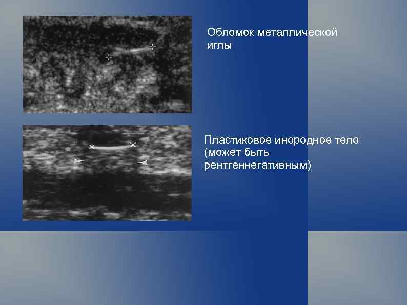 Обломок металлической иглы Пластиковое инородное тело (может быть рентгеннегативным) 