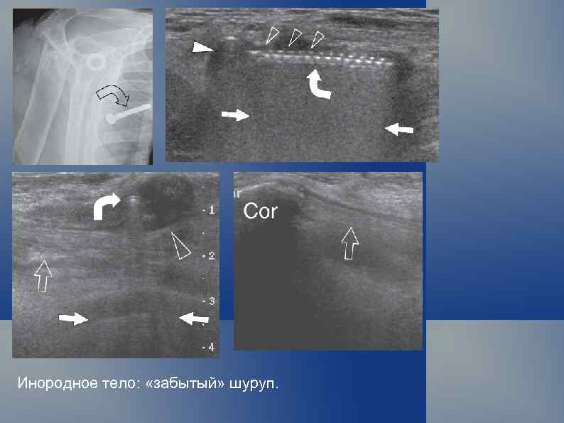 Инородное тело: «забытый» шуруп. 