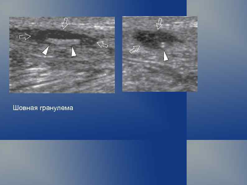 Шовная гранулема 