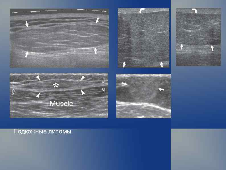 Подкожные липомы 
