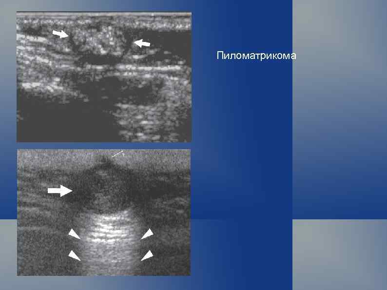 Пиломатрикома 