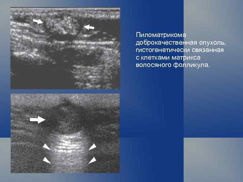 Пиломатрикома доброкачественная опухоль, гистогенетически связанная с клетками матрикса волосяного фолликула. 