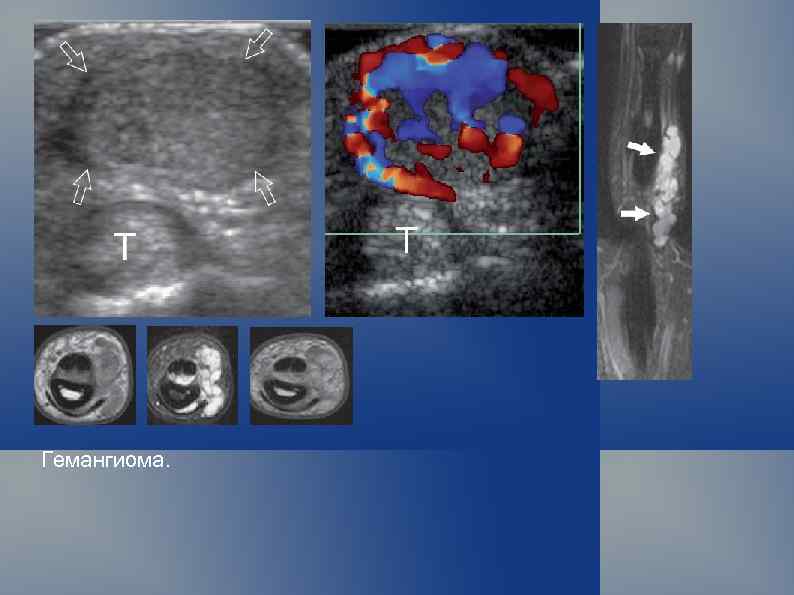 Гемангиома. 