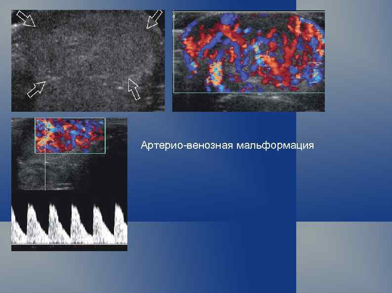 Артерио-венозная мальформация 