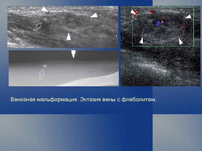 Венозная мальформация. Эктазия вены с флеболитам. 