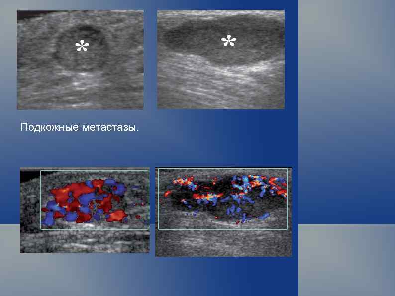 Метастазы что это. Метастазы мягких тканей на УЗИ. Метастазы в мягких тканях. Меланома на УЗИ мягких тканей.