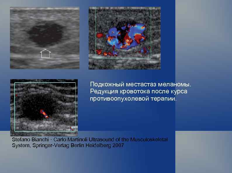 Подкожный местастаз меланомы. Редукция кровотока после курса противоопухолевой терапии. Stefano Bianchi · Carlo Martinoli