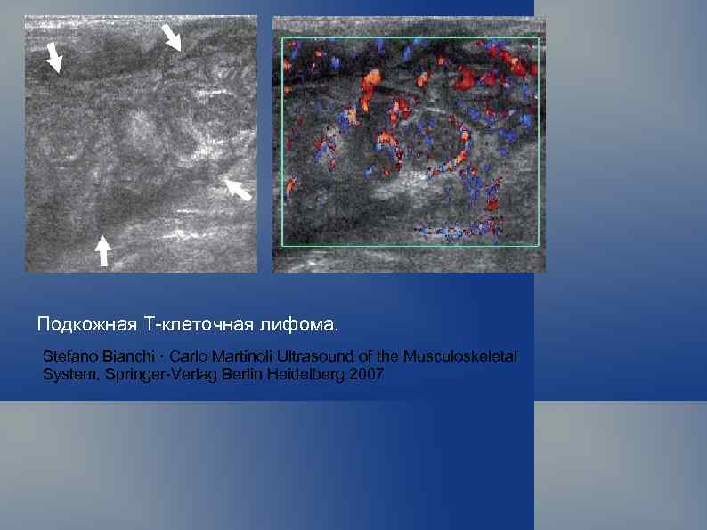 Подкожная Т-клеточная лифома. Stefano Bianchi · Carlo Martinoli Ultrasound of the Musculoskeletal System, Springer-Verlag