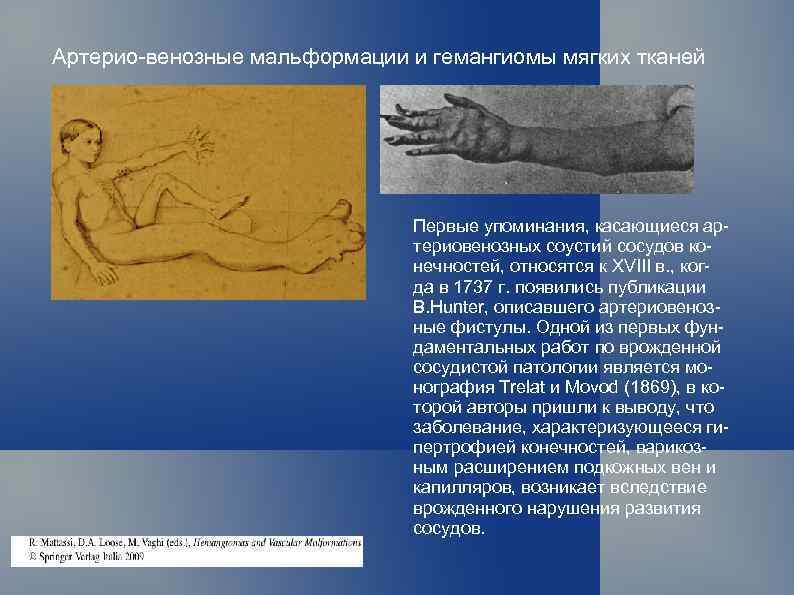 Артерио-венозные мальформации и гемангиомы мягких тканей Первые упоминания, касающиеся артериовенозных соустий сосудов конечностей, относятся