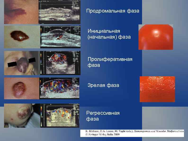 Продромальная фаза Инициальная (начальная) фаза Пролиферативная фаза Зрелая фаза Регрессивная фаза 