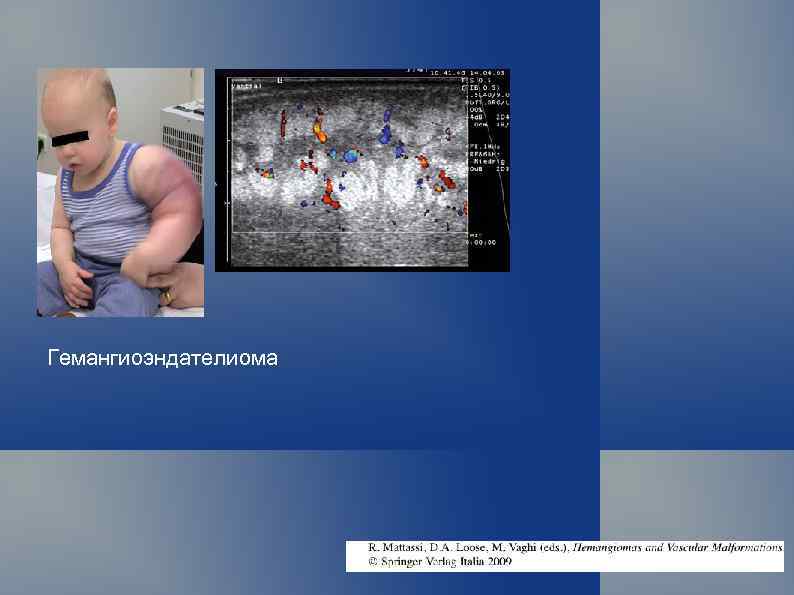 Гемангиоэндателиома 