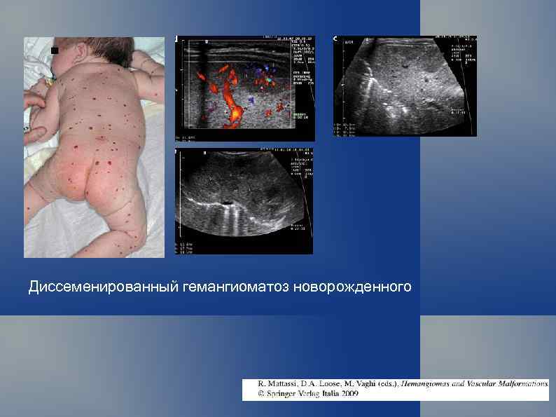 Диссеменированный гемангиоматоз новорожденного 