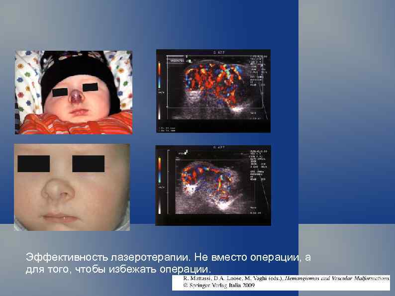 Эффективность лазеротерапии. Не вместо операции, а для того, чтобы избежать операции. 