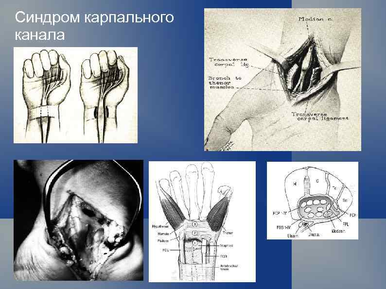 Синдром карпального клапана кисти