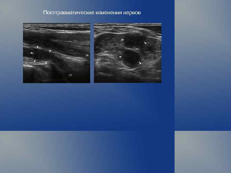 Посттравматические изменения нервов 