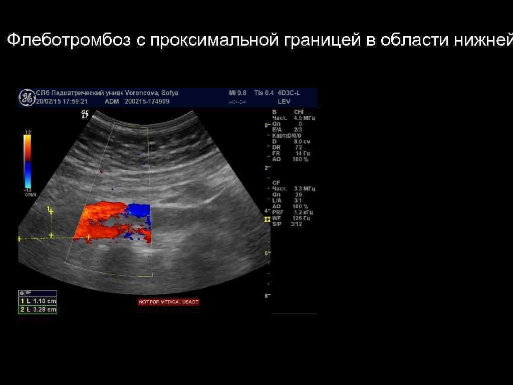 Флеботромбоз с проксимальной границей в области нижней 