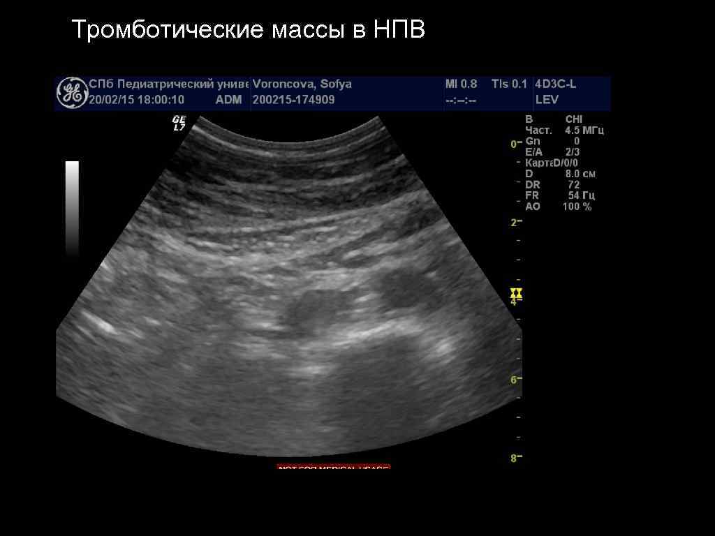 Тромботические массы в НПВ 