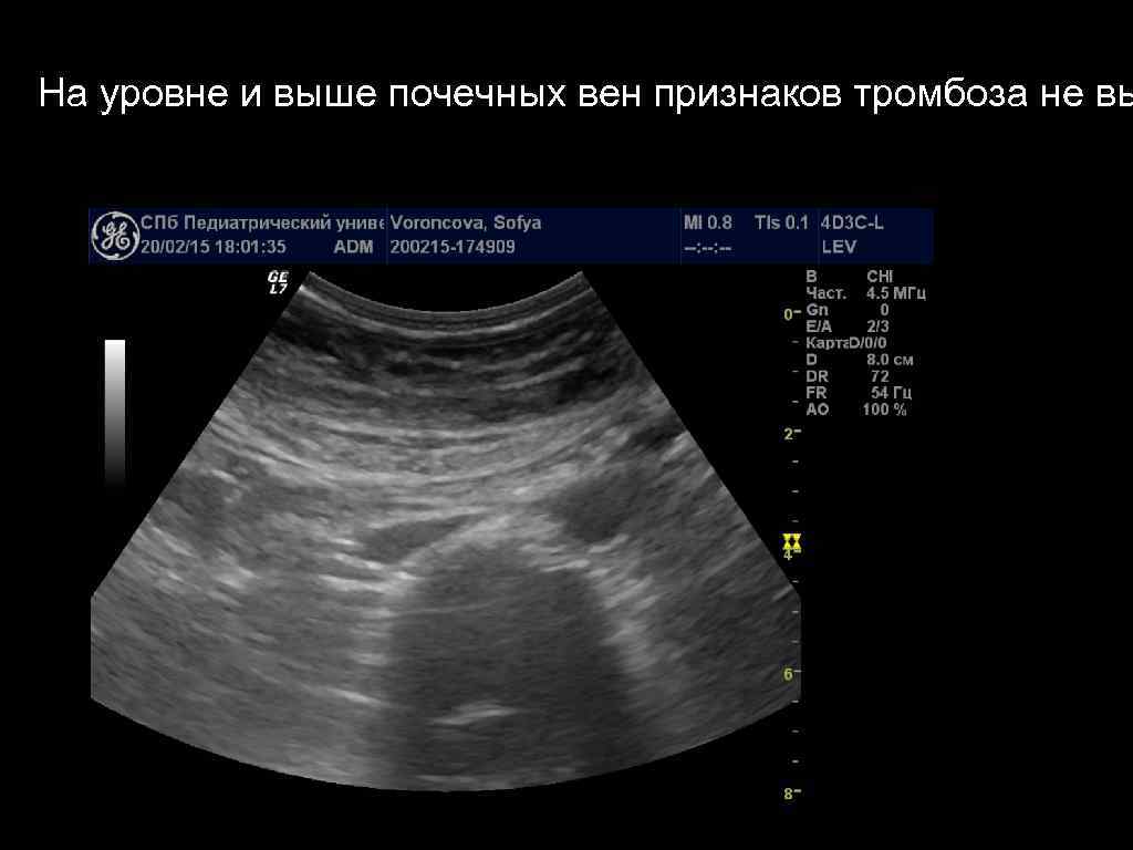 На уровне и выше почечных вен признаков тромбоза не вы 