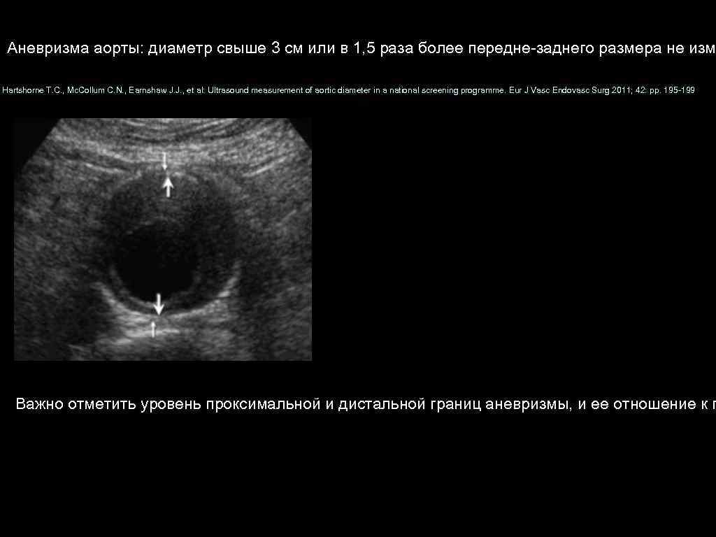 Аневризма аорты: диаметр свыше 3 см или в 1, 5 раза более передне заднего