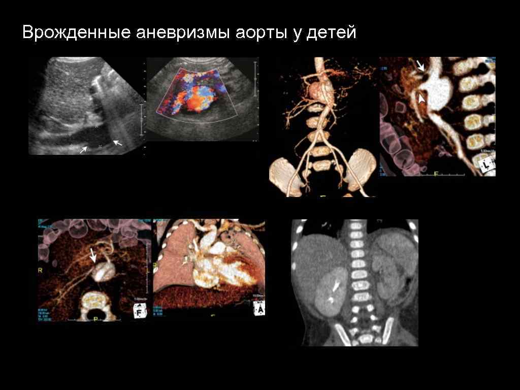 Врожденные аневризмы аорты у детей 