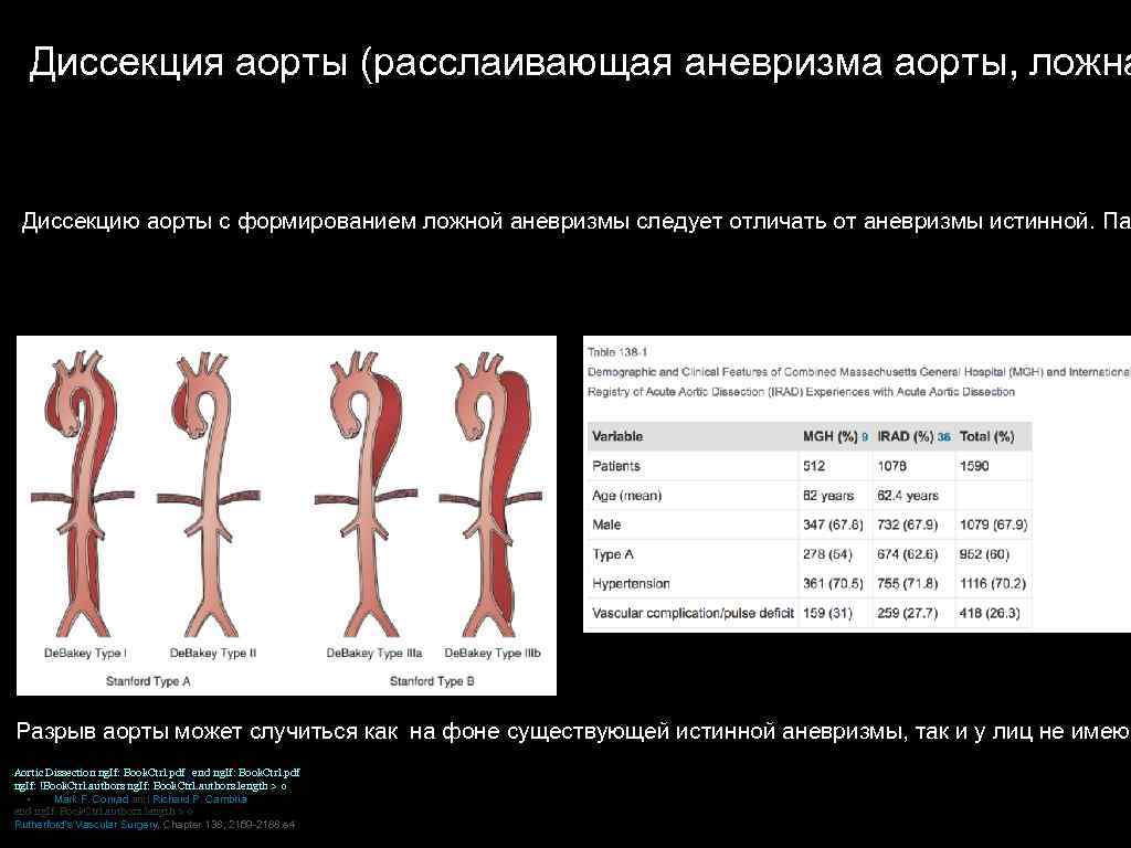 Диссекция аорты (расслаивающая аневризма аорты, ложна Диссекцию аорты с формированием ложной аневризмы следует отличать