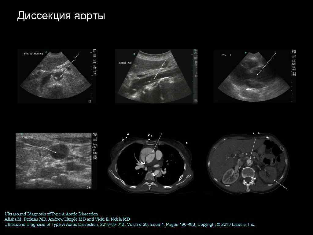 Диссекция аорты Ultrasound Diagnosis of Type A Aortic Dissection Alisha M. Perkins MD, Andrew