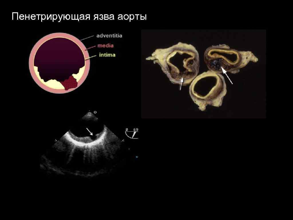 Пенетрирующая язва аорты 