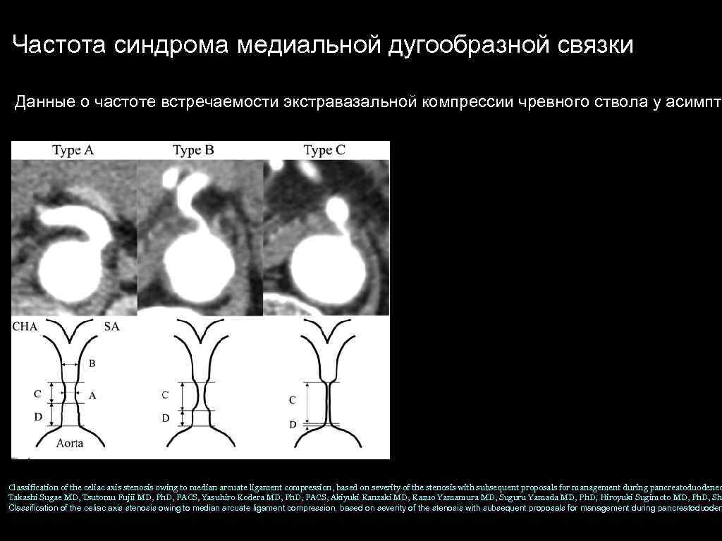 Частота синдрома медиальной дугообразной связки Данные о частоте встречаемости экстравазальной компрессии чревного ствола у