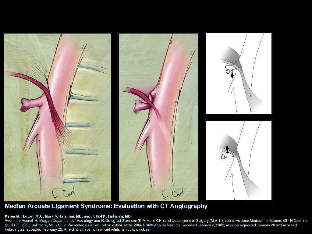 Median Arcuate Ligament Syndrome: Evaluation with CT Angiography Karen M. Horton, MD, , Mark