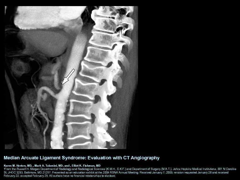 Median Arcuate Ligament Syndrome: Evaluation with CT Angiography Karen M. Horton, MD, , Mark