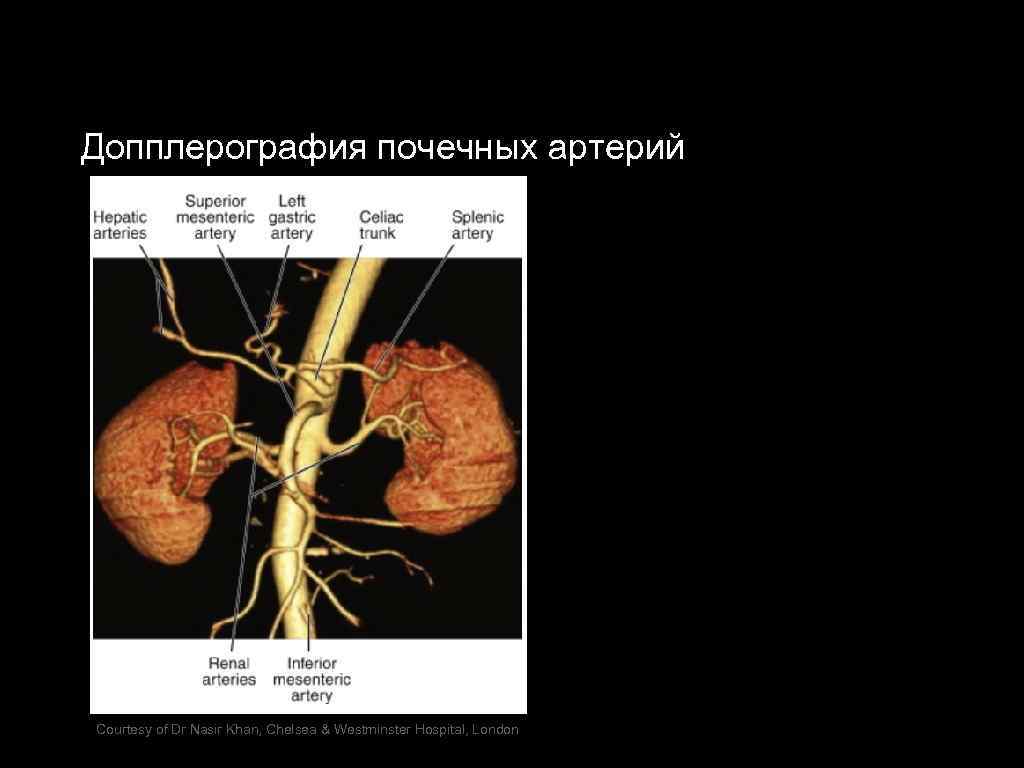 Допплерография почечных артерий Courtesy of Dr Nasir Khan, Chelsea & Westminster Hospital, London 