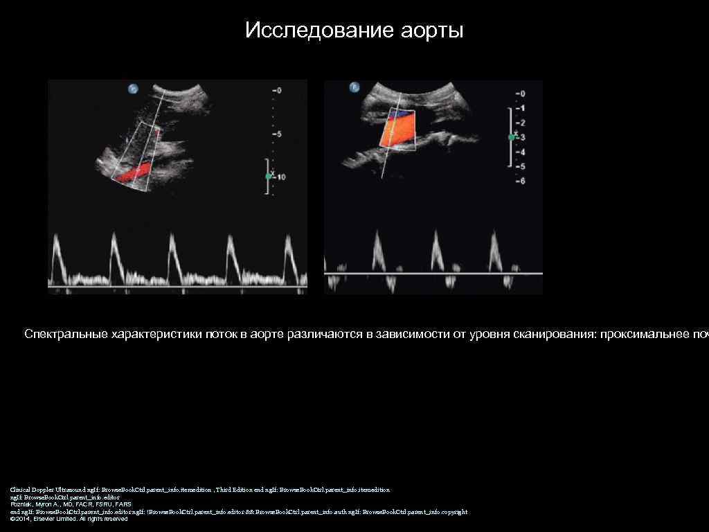 Исследование аорты Спектральные характеристики поток в аорте различаются в зависимости от уровня сканирования: проксимальнее