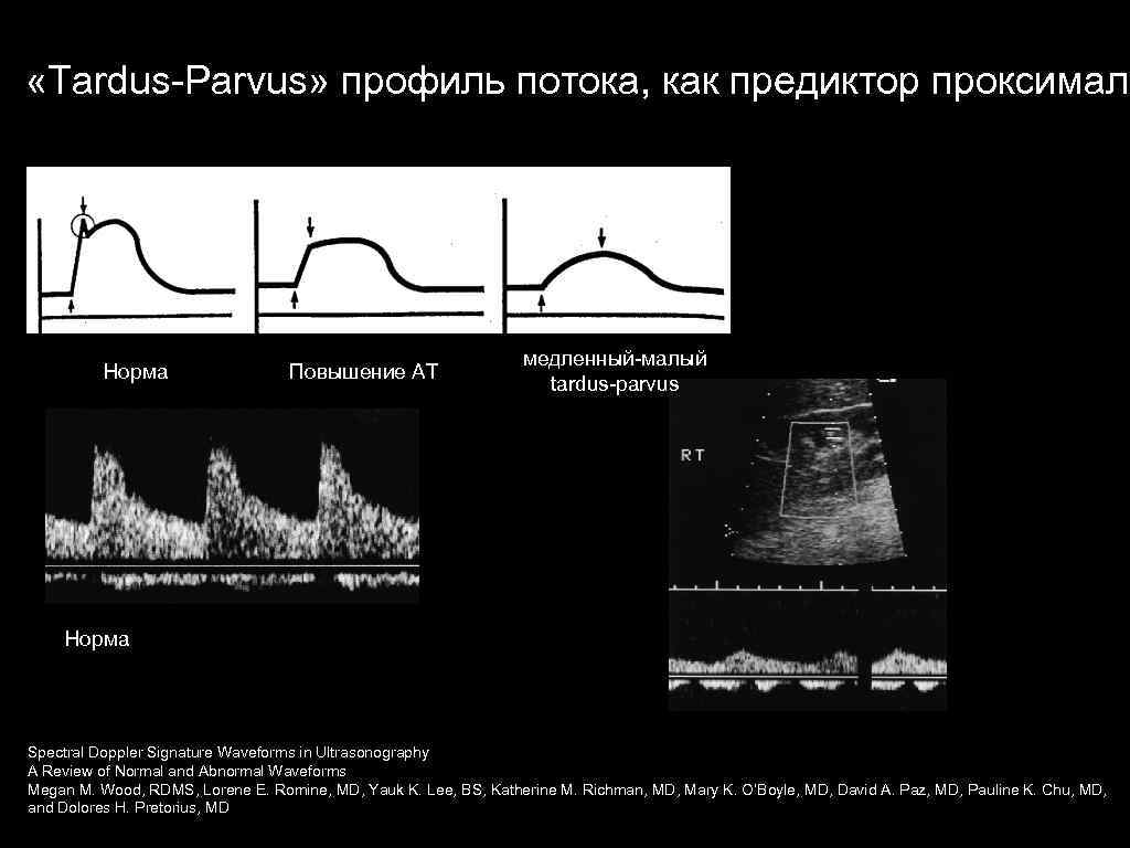  «Tardus Parvus» профиль потока, как предиктор проксималь Норма Повышение АТ медленный малый tardus