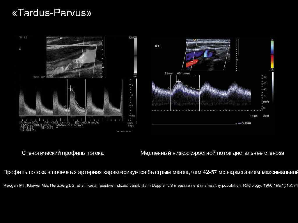  «Tardus Parvus» Стенотический профиль потока Медленный низкоскоростной поток дистальнее стеноза Профиль потока в