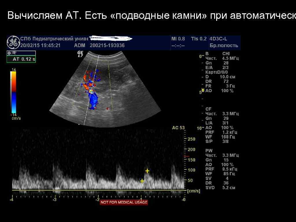 Вычисляем АТ. Есть «подводные камни» при автоматическ 