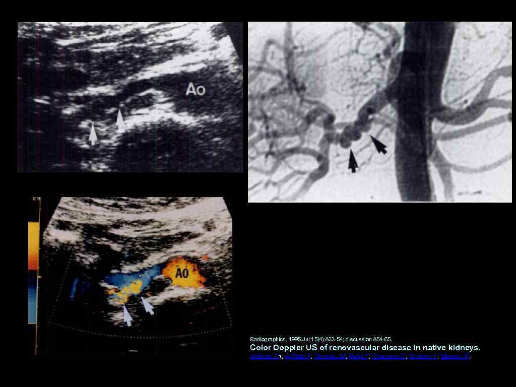 Radiographics. 1995 Jul; 15(4): 833 54; discussion 854 65. Color Doppler US of renovascular