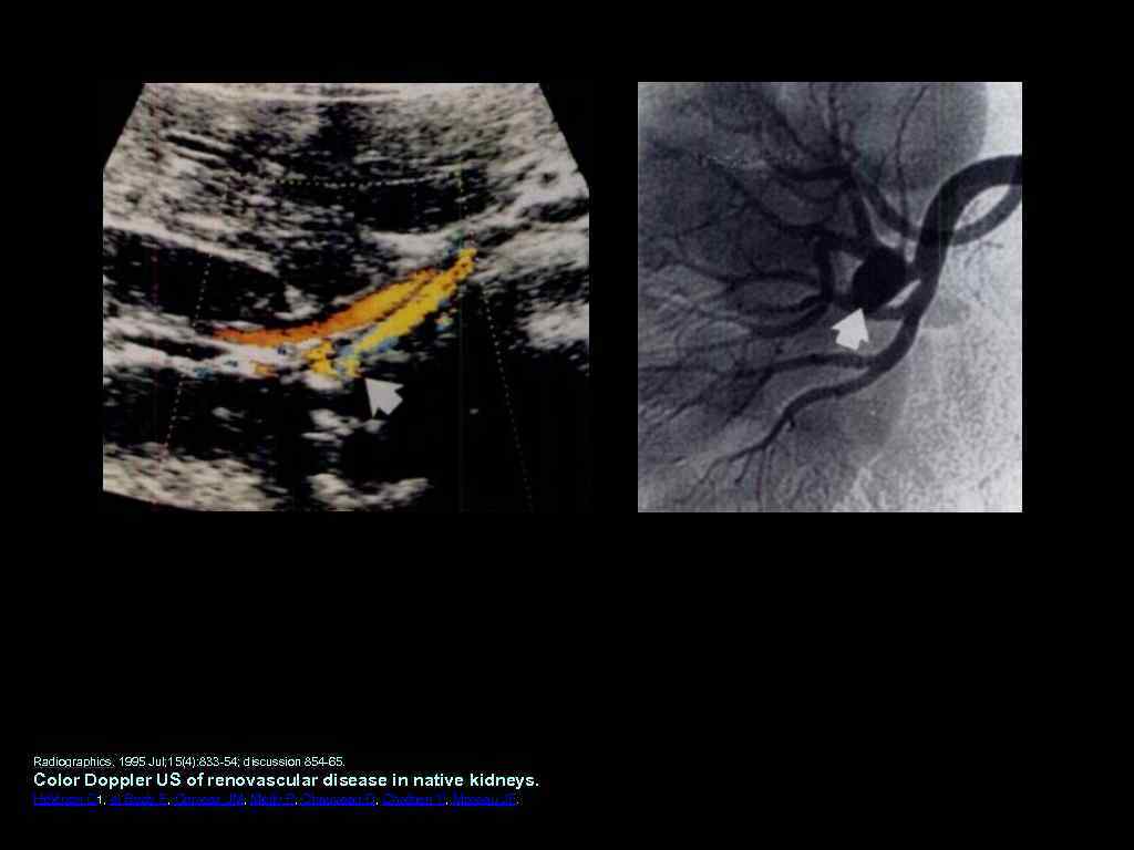 Radiographics. 1995 Jul; 15(4): 833 54; discussion 854 65. Color Doppler US of renovascular
